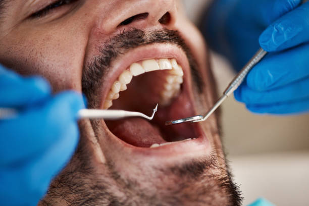 Best Emergency Wisdom Tooth Extraction in Sharpsville, PA